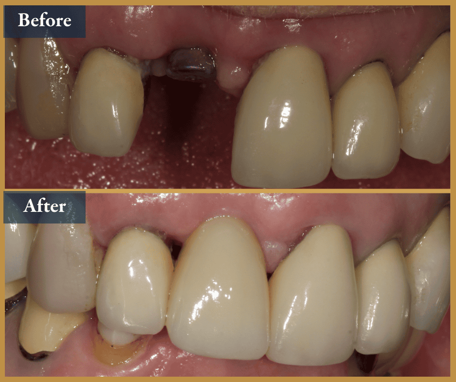 dental implant brisbane