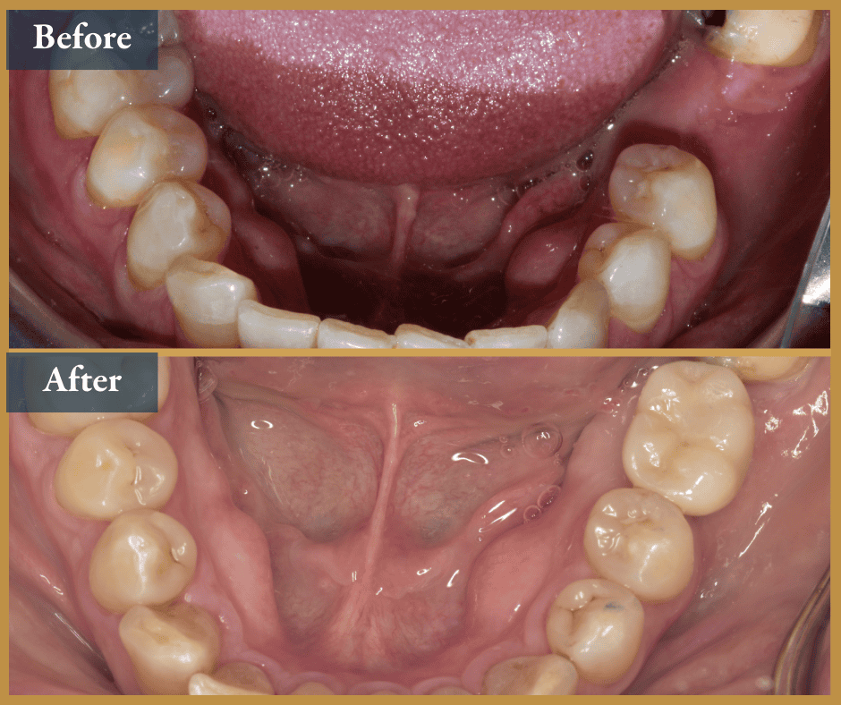 Dental Implants Brisbane