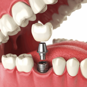 dental implants brisbane