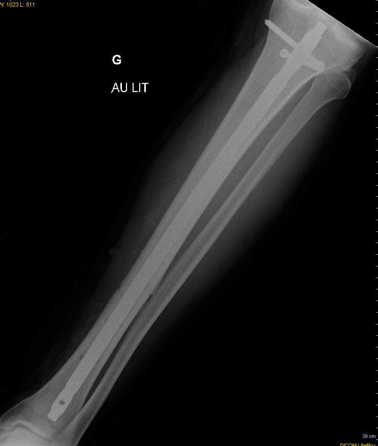 Screw and Rod in Leg after Car hit Pedestrian in Miami car crash.