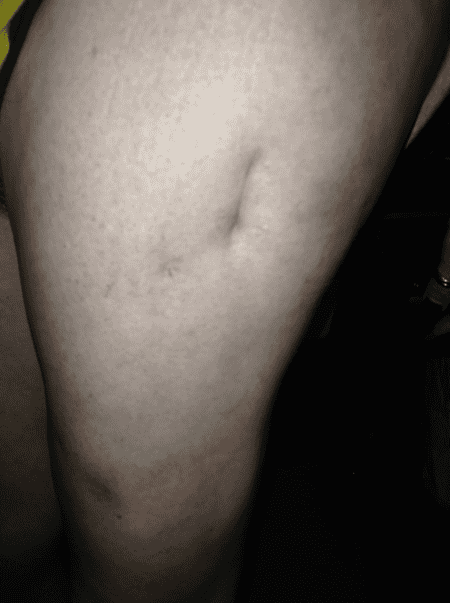 Permanent scar from hip surgery.