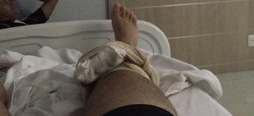 ice compress knee1