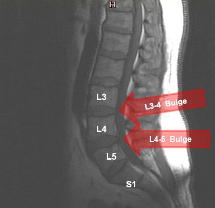 Bulging discs