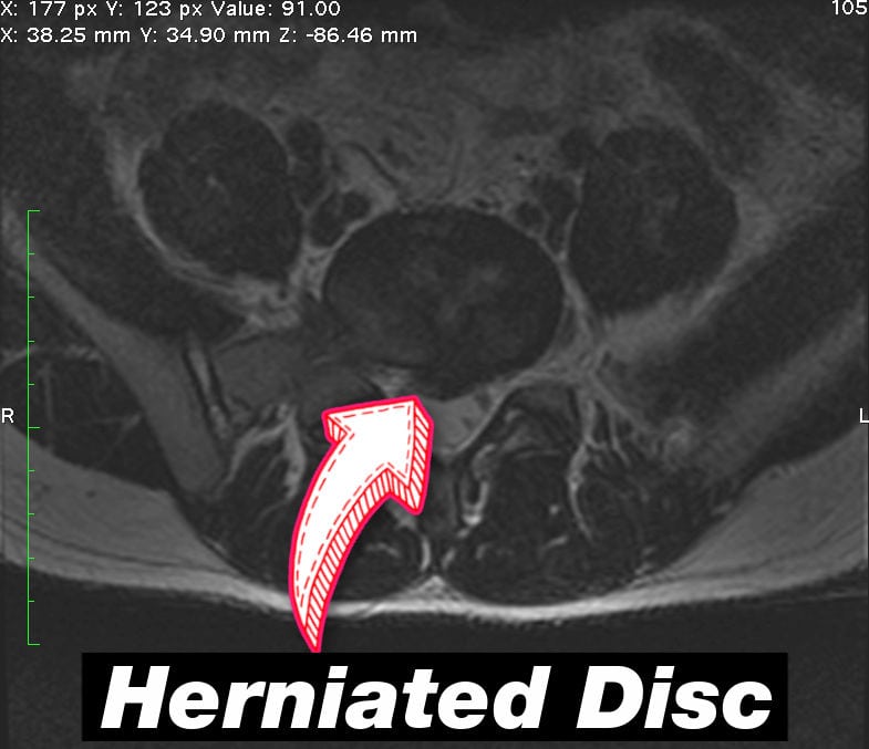 herniated disc