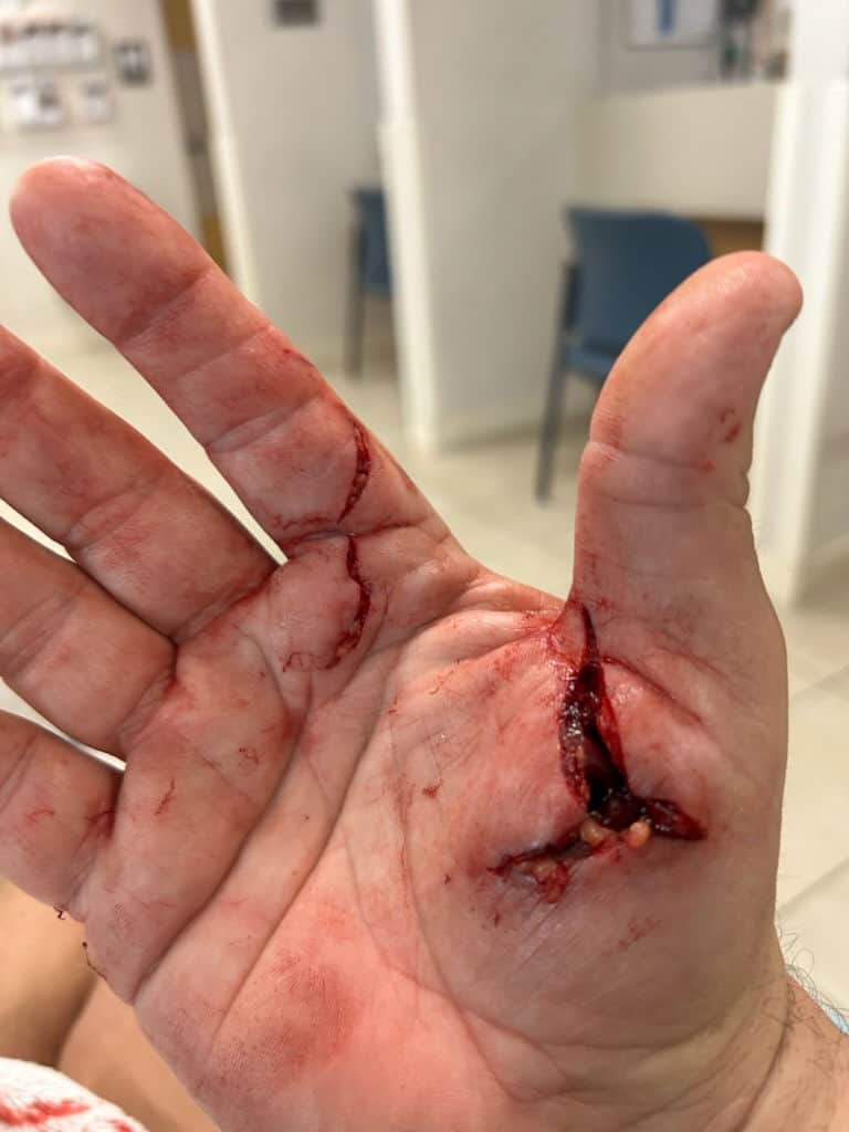 2 dog bite wounds to a man's hand