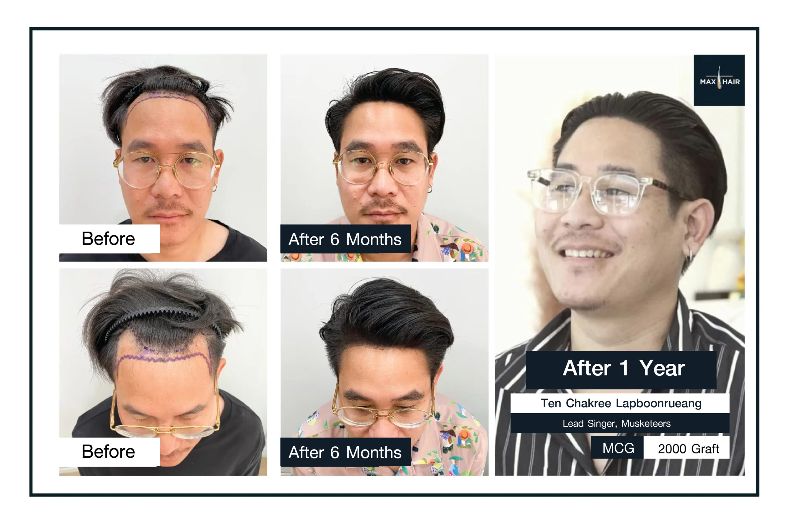Permanent Hair Transplant Review by Ten Chakree Lapboonrueang