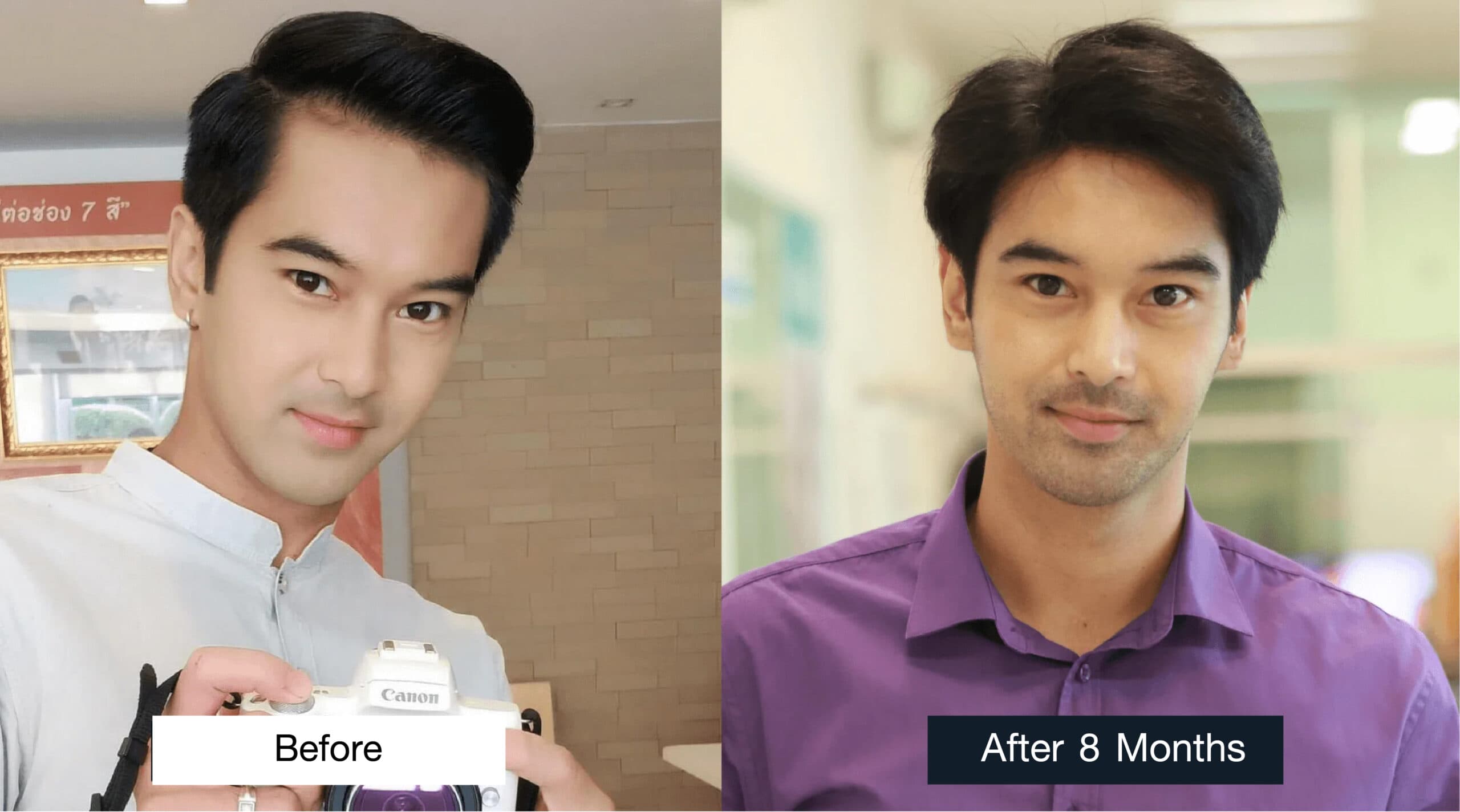 Photos of Off Chanaphon Sattaya before and 8 months after hair transplantation