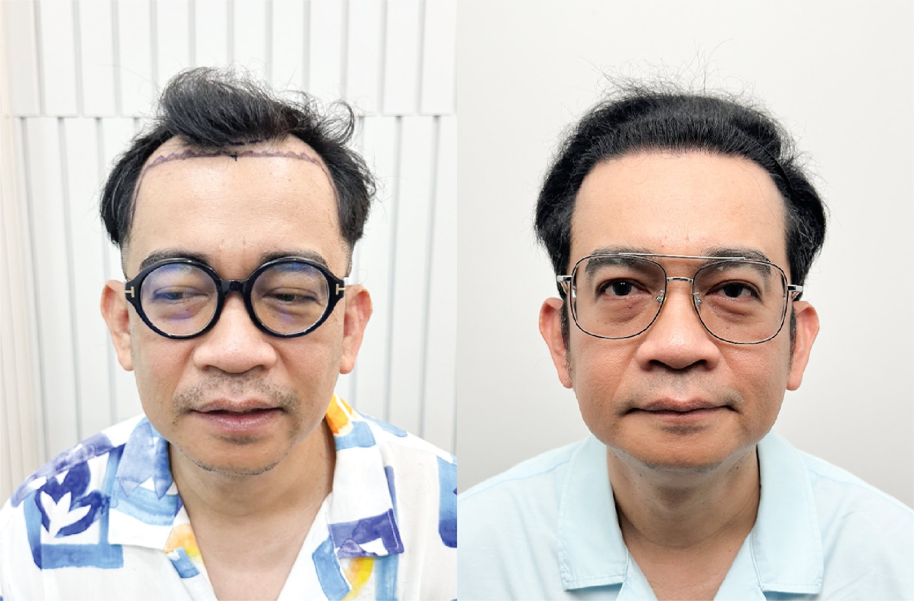 รีวิวก่อนและหลังการปลูกผมของคุณพัน พลุแตก (พิธีกร นักแสดงตลก)