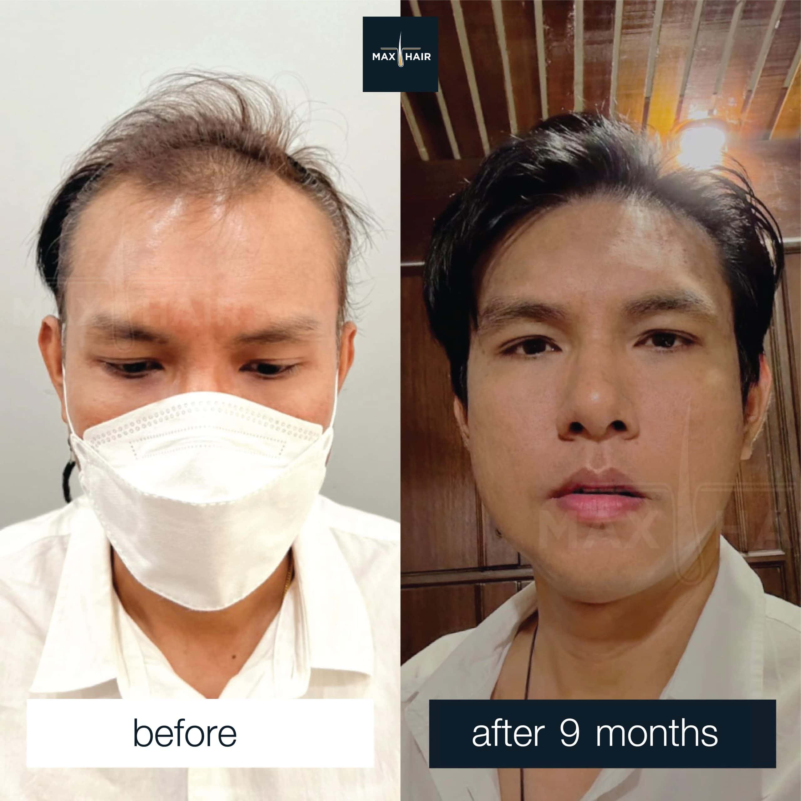 male hair transplant using the FUE technique, 2,500 grafts.