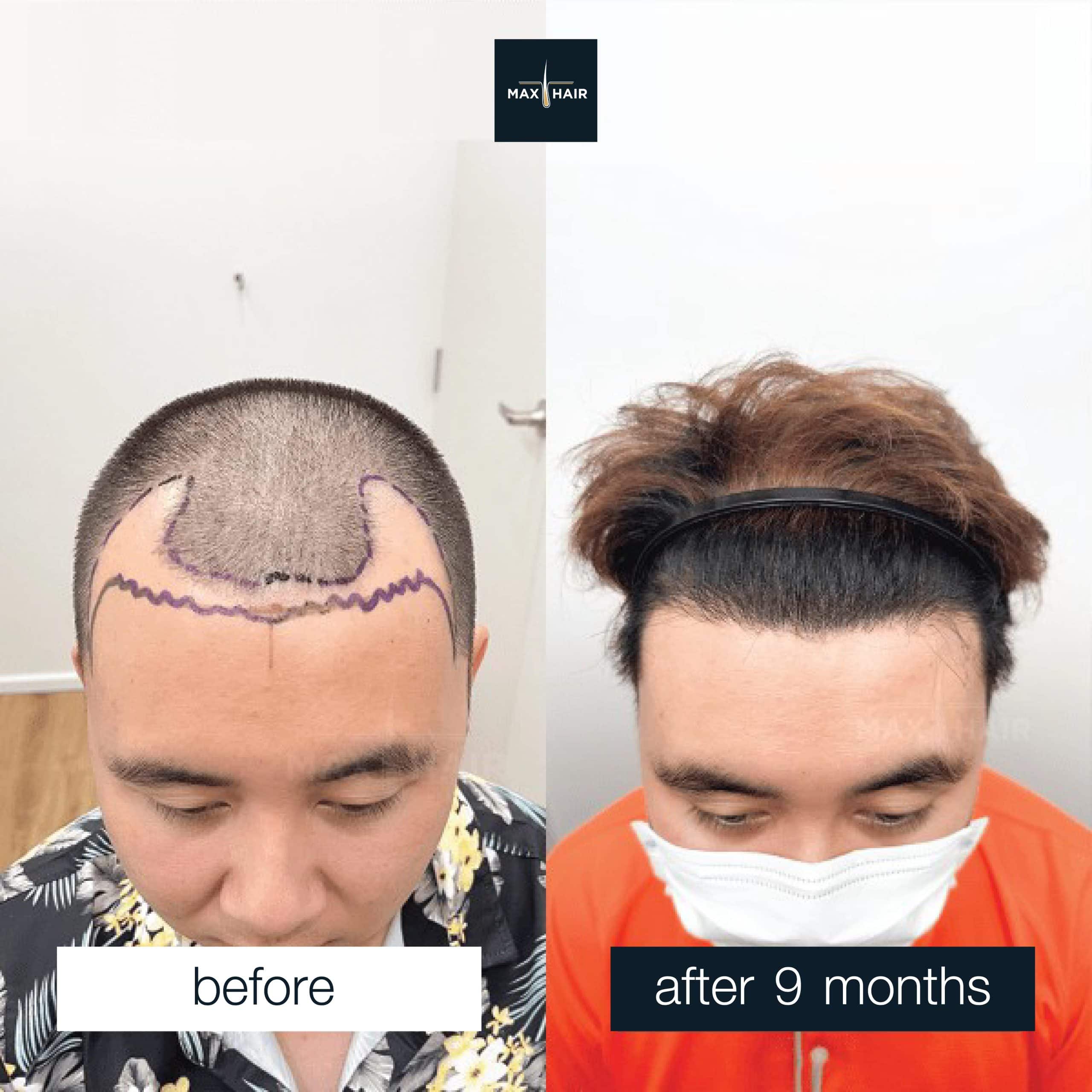 a male hair transplant review case, MCG technique, 2,300 grafts