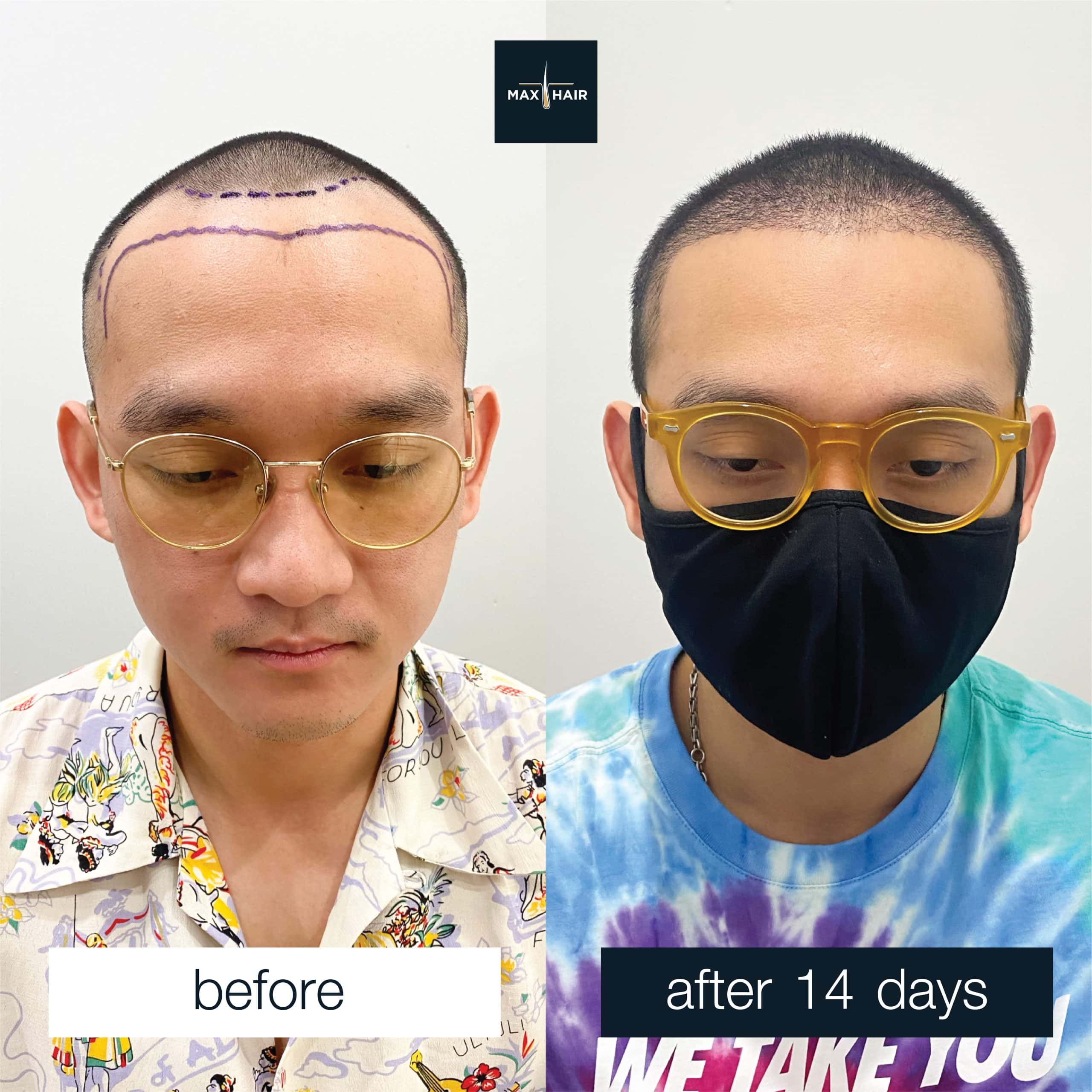 Before and after male hair transplant results showing dramatic transformation