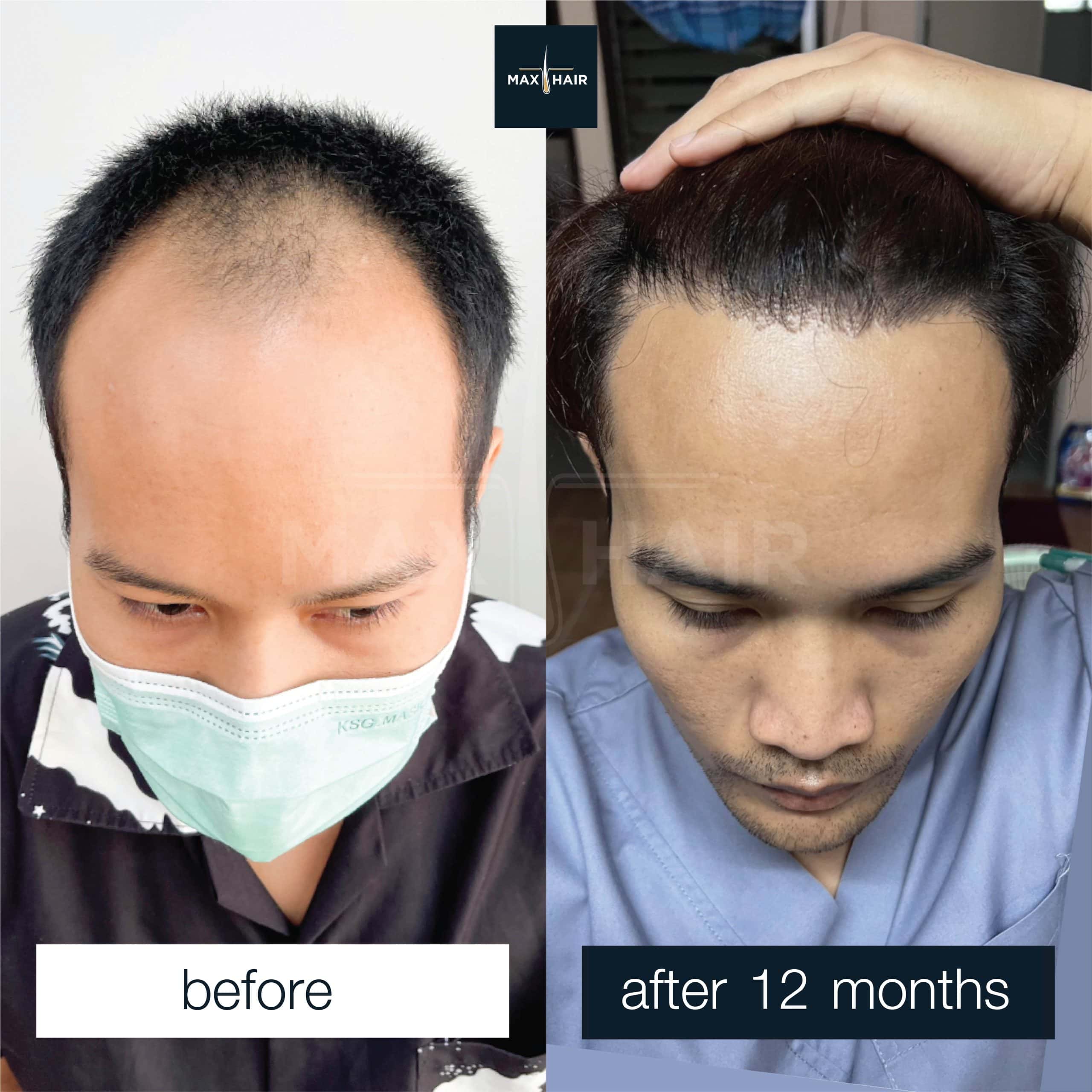 Before and after MCG 3,200 grafts hair transplant in a man, 12 months result