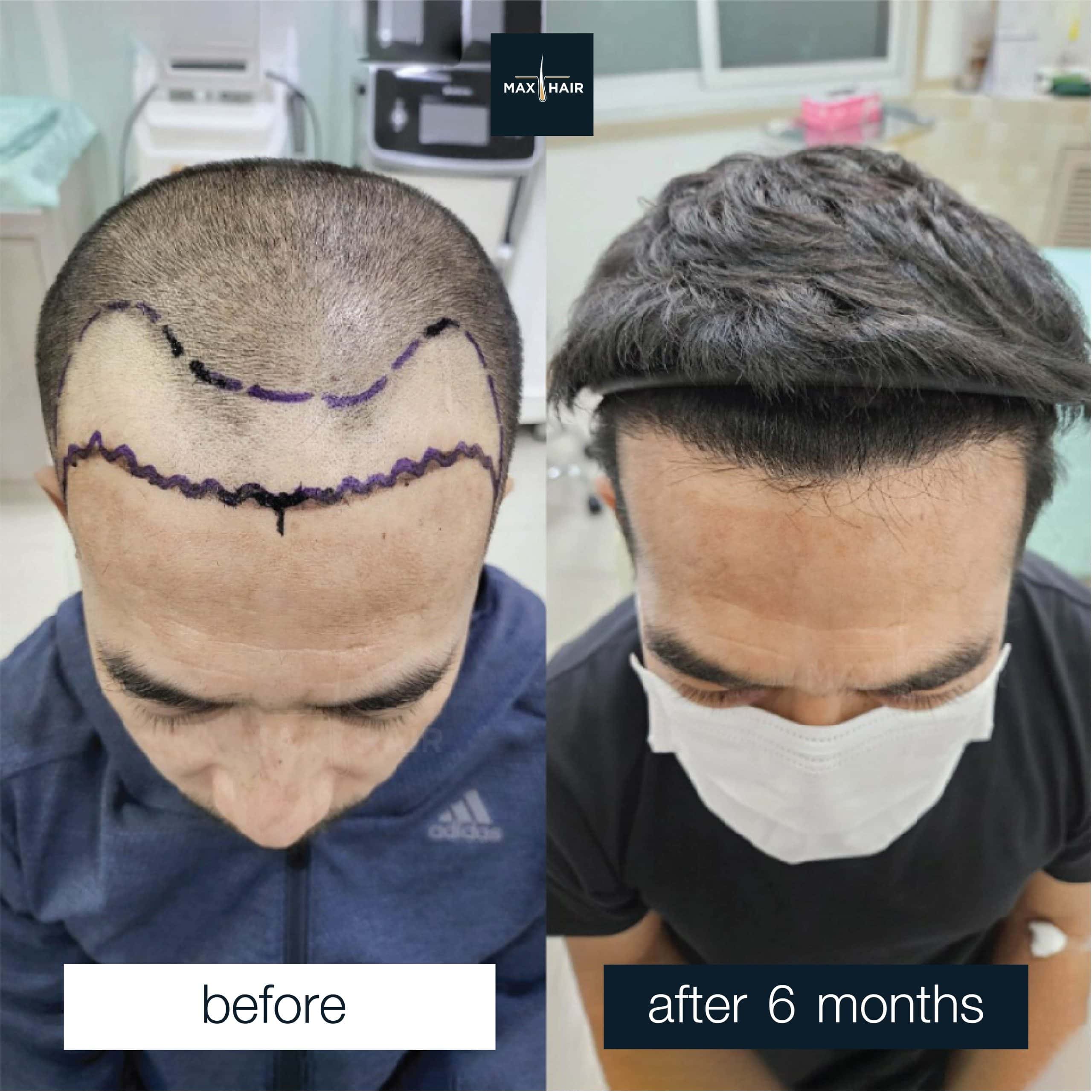 Before and after MCG 2,550 grafts hair transplant in a man, 6 months result