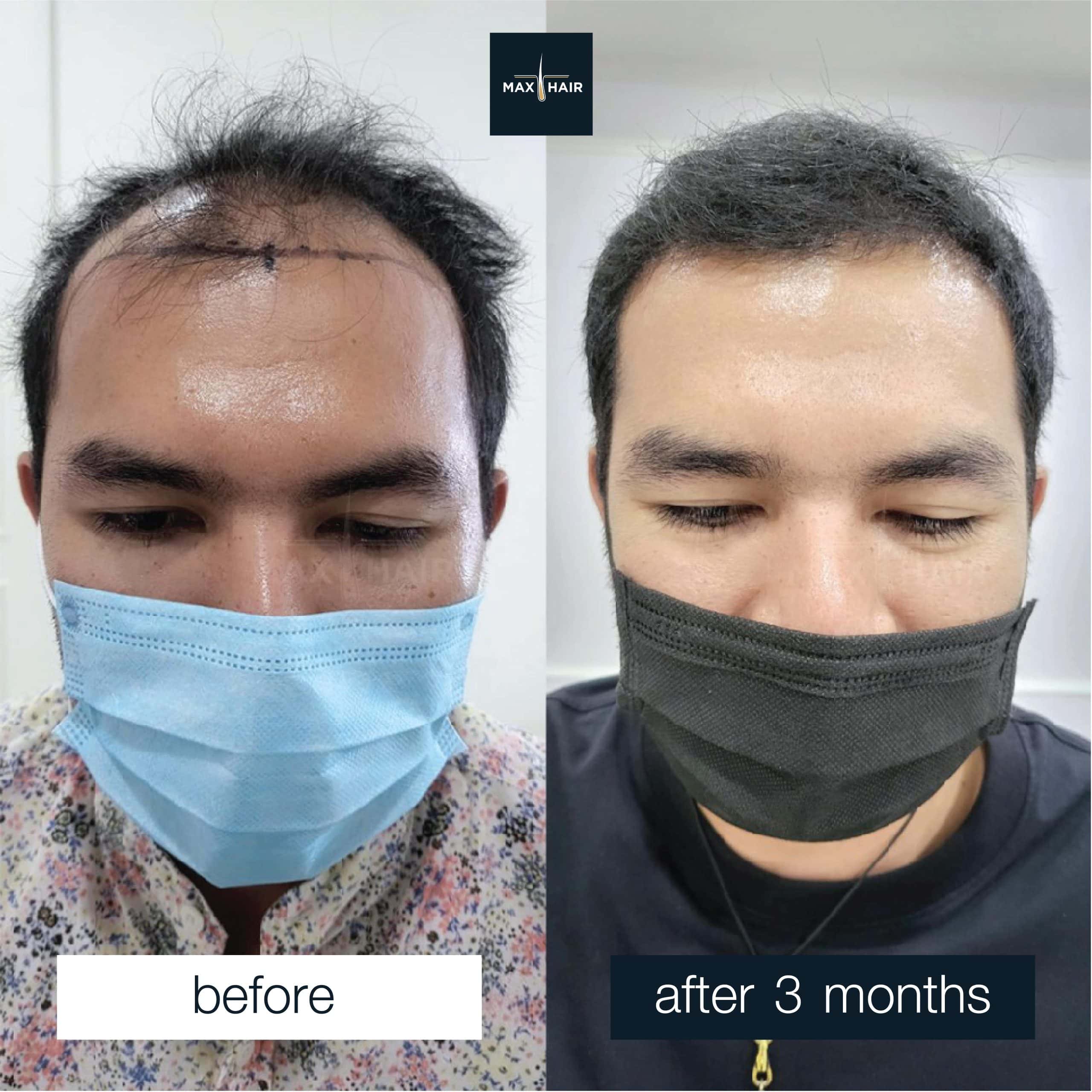 Hairline transformation after successful hair restoration