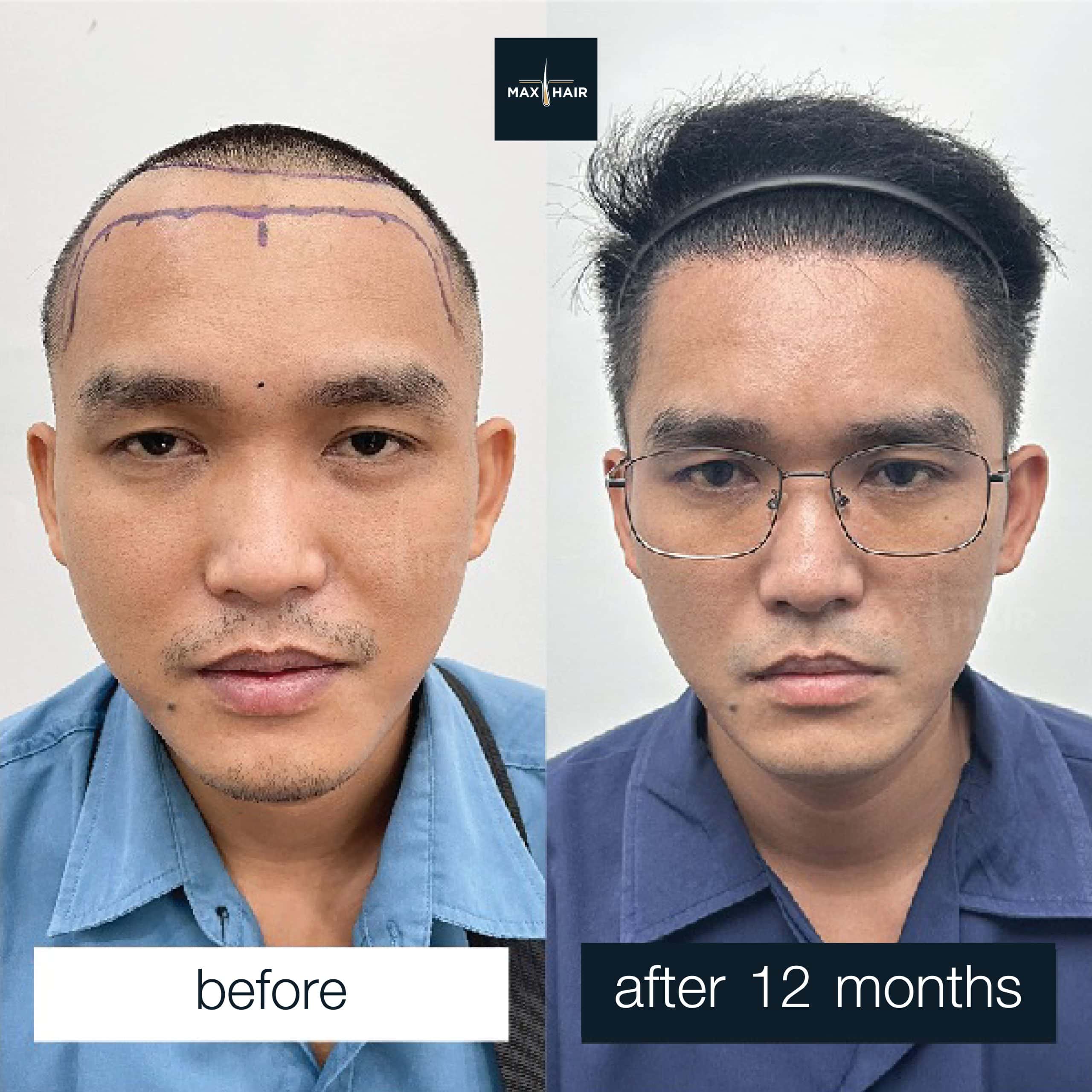 Hair transplant MCG 2,500 grafts results after 12 months