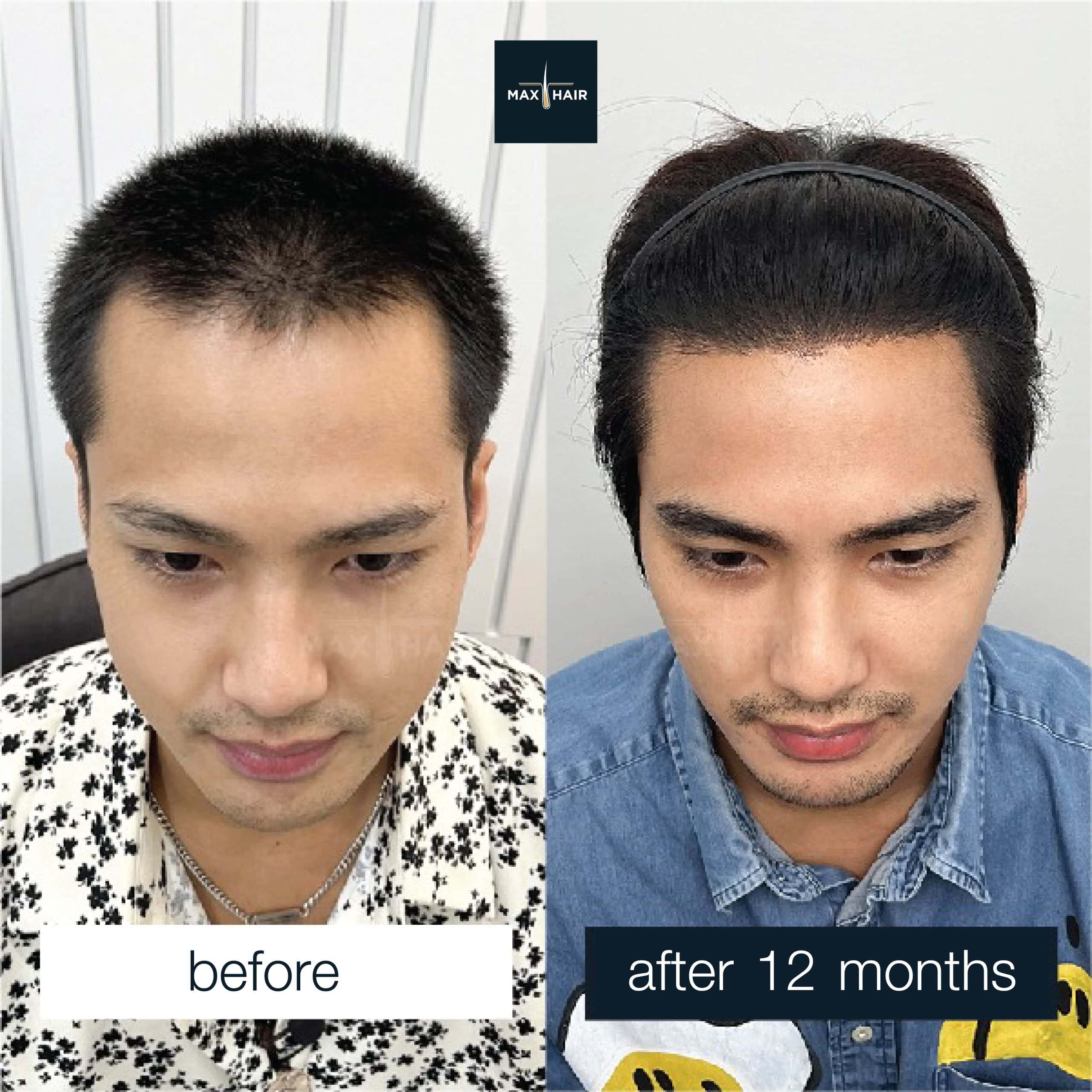 Real case review: male hair transplant before and after results from Max Hair