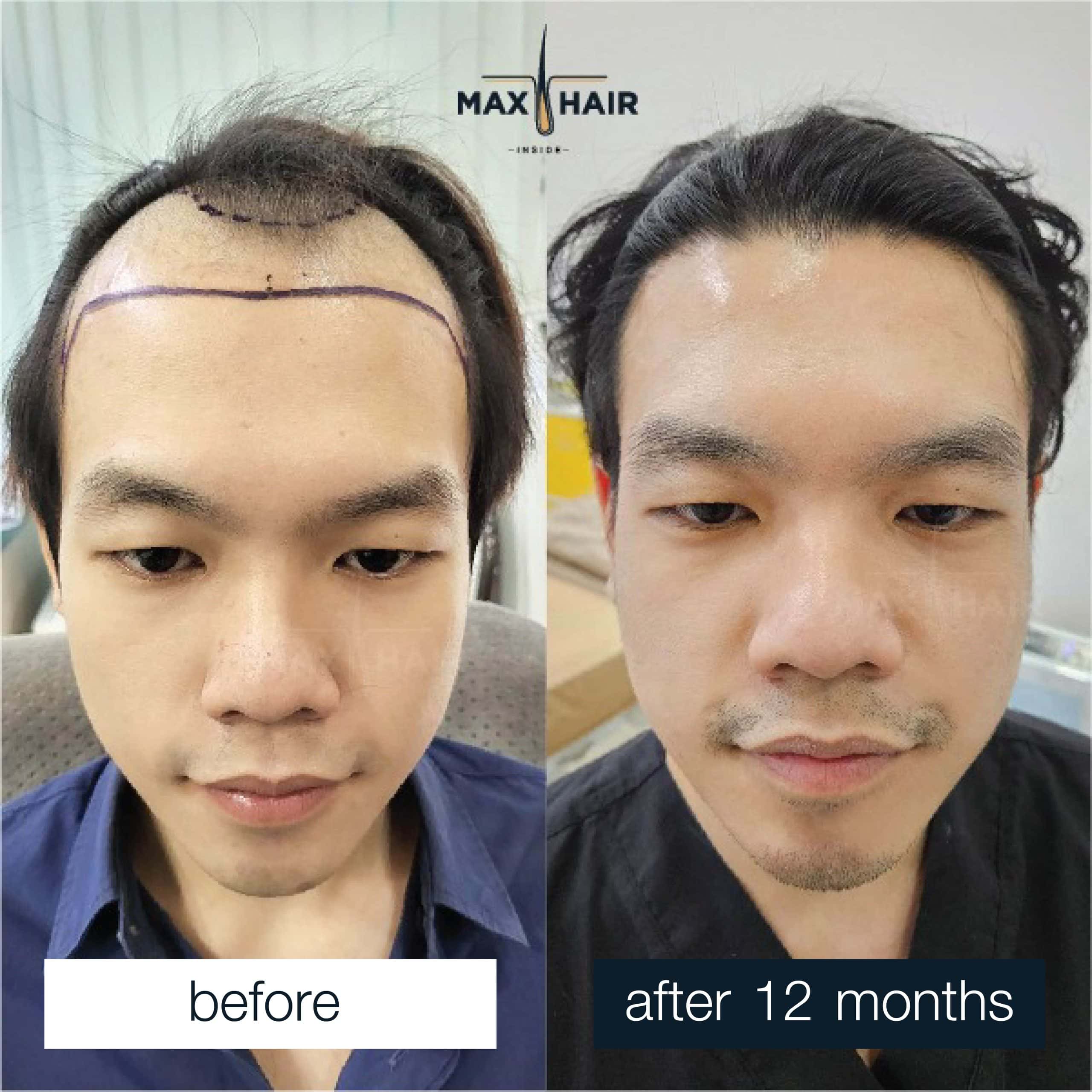 1-year hair transplant result in man with restored hairline and natural-looking density.