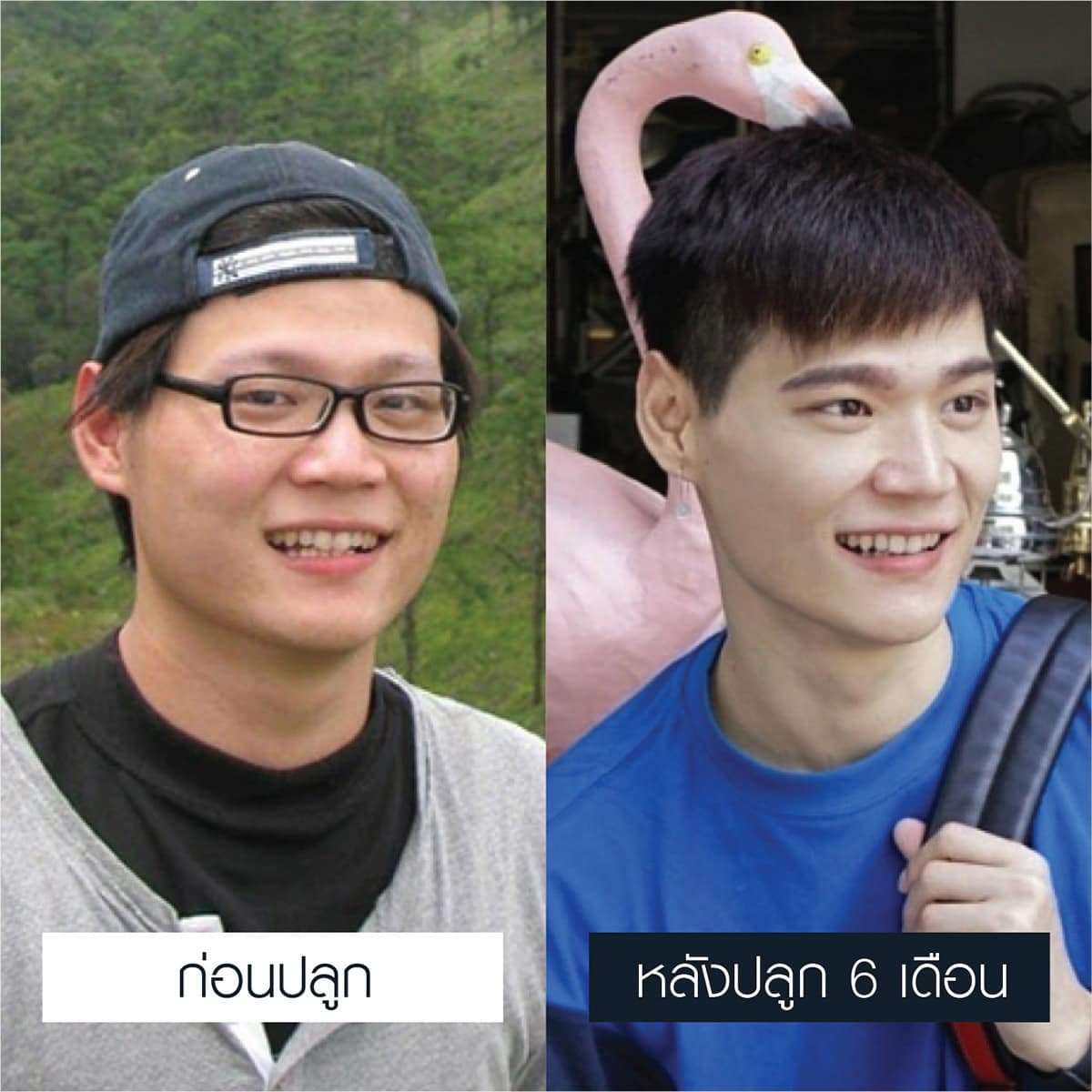 รีวิวปลูกคิ้ว เชื่อมั่นได้ - Max Hair (3)