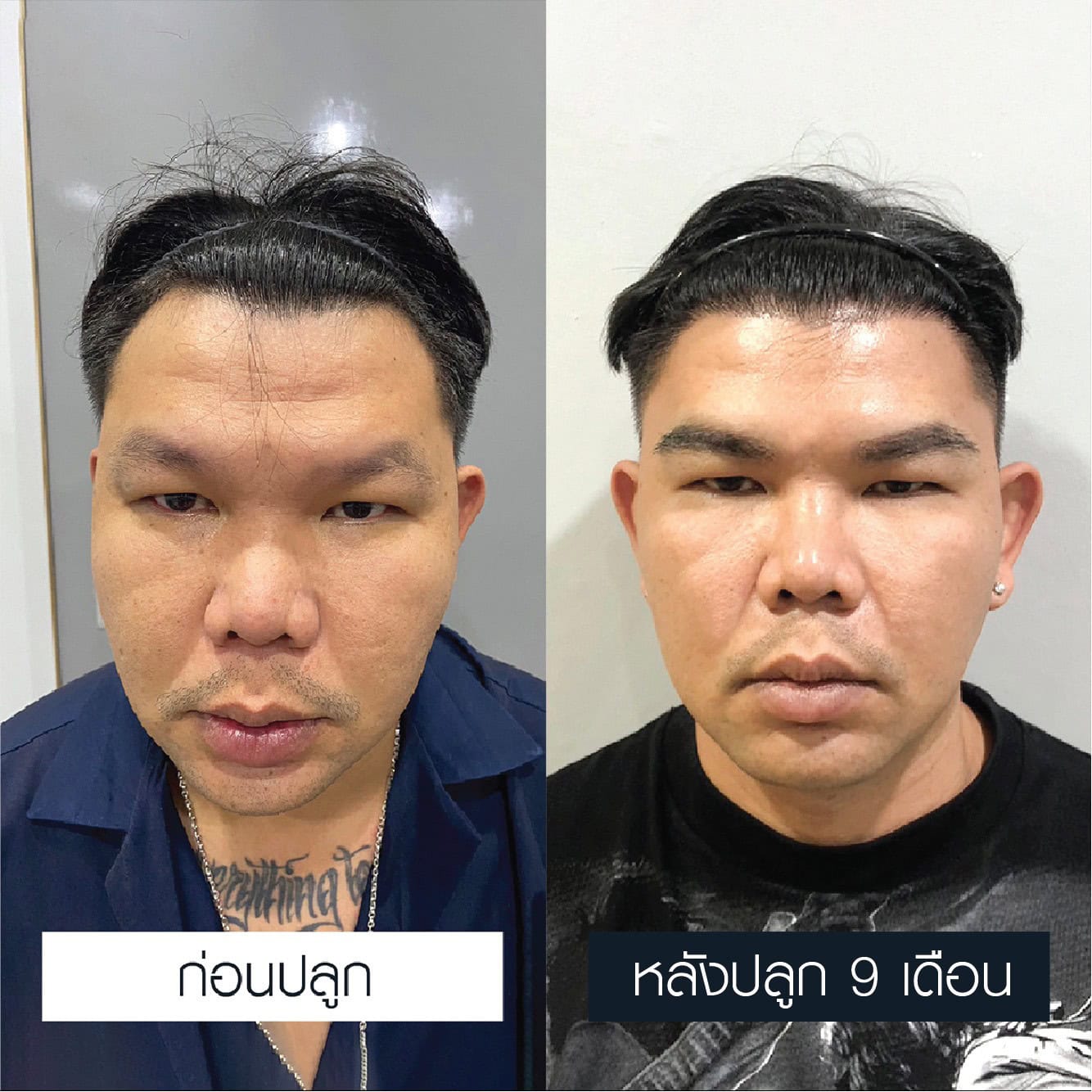 รีวิวผลลัพธ์เปรียบเทียบ 9 เดือนก่อน-หลังการปลูกคิ้วของผู้ชาย