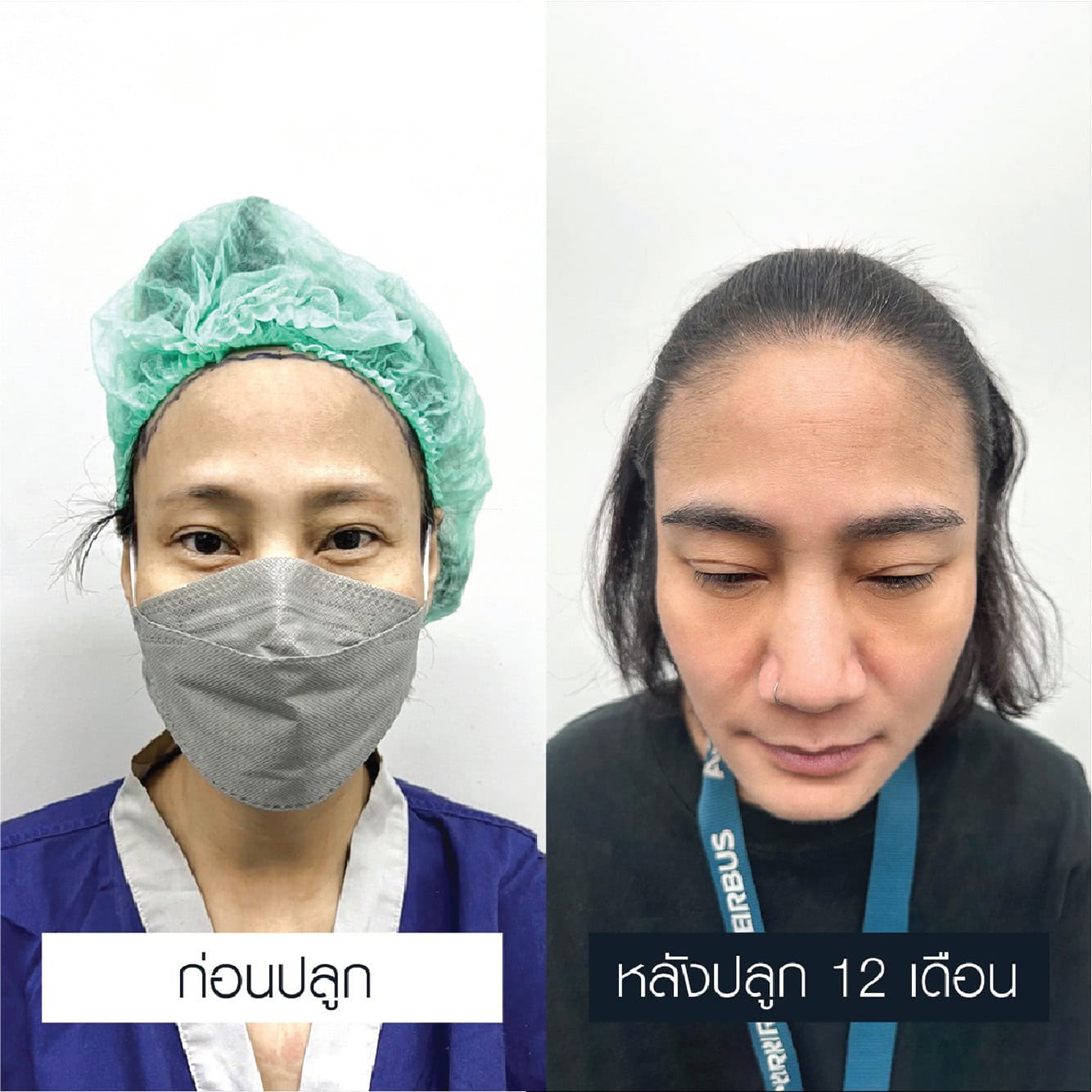 รีวิวปลูกคิ้ว เชื่อมั่นได้ - Max Hair (1)