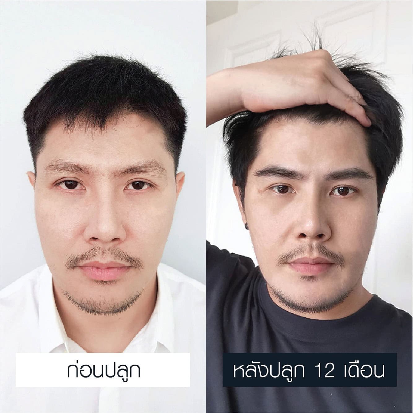 รีวิวปลูกคิ้ว เชื่อมั่นได้ - Max Hair (2)