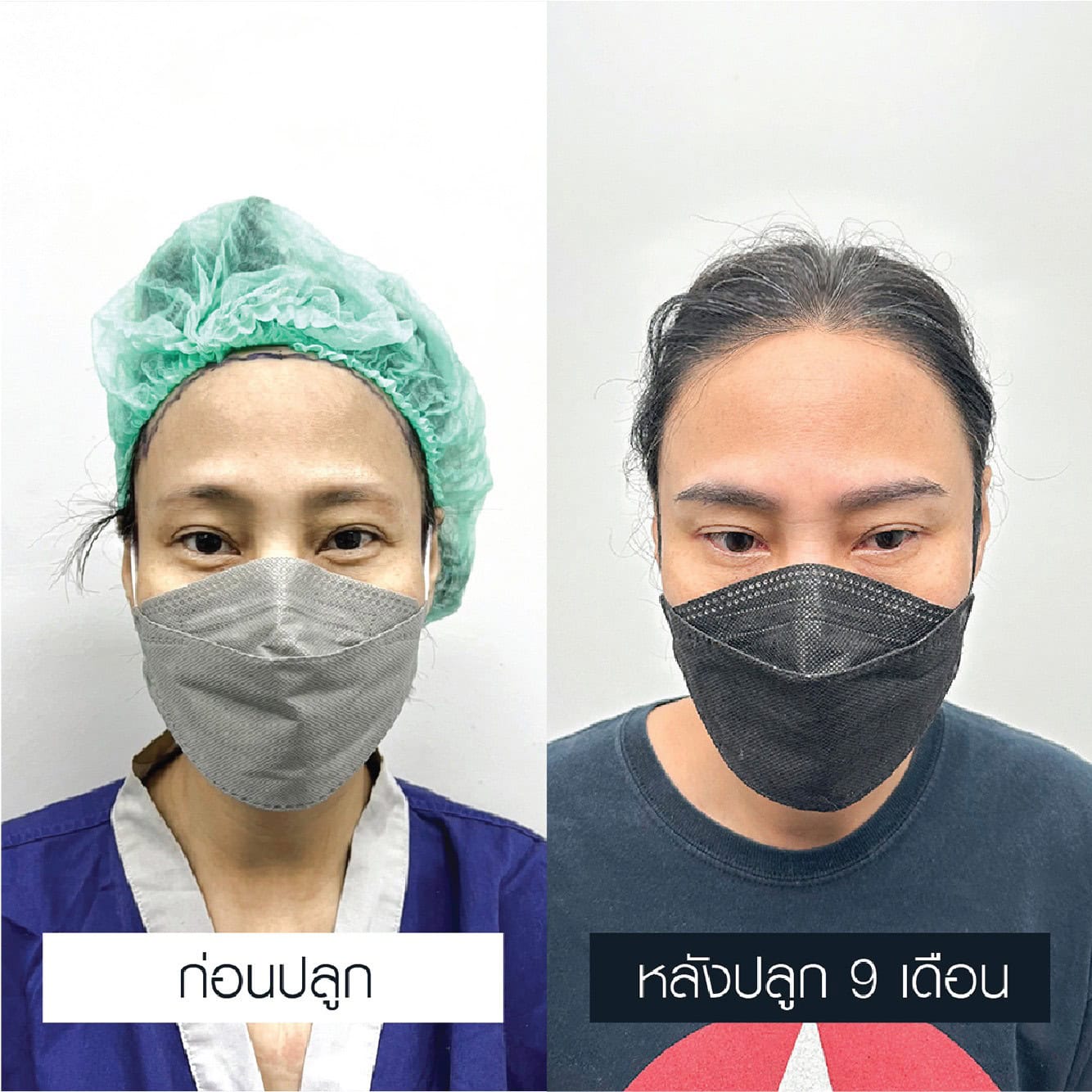 เปรียบเทียบก่อนและหลังปลูกคิ้วผู้หญิง 600 กราฟต์ หลังผ่านไป 9 เดือน