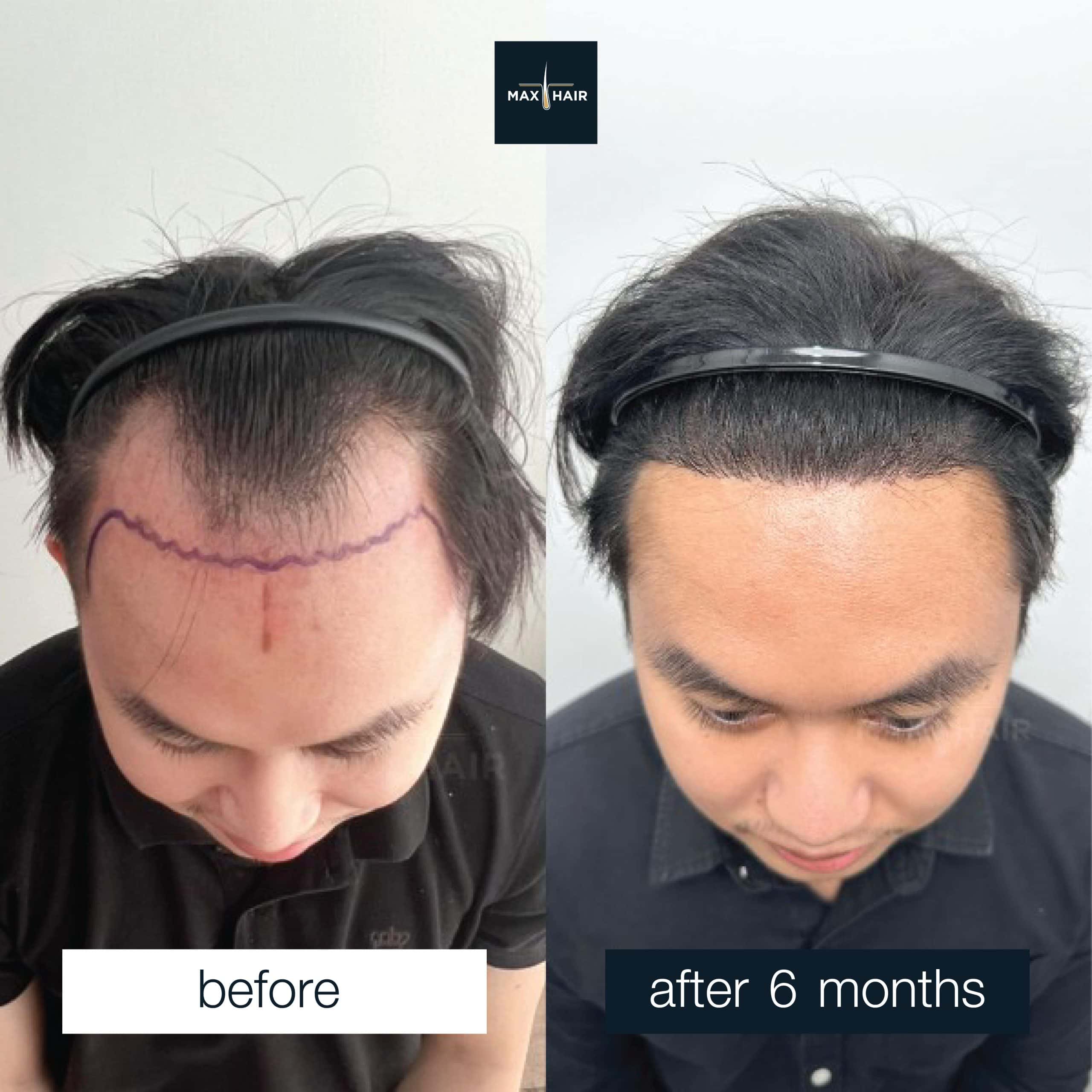Male hair transplant results MCG 2,500 grafts after 6 months