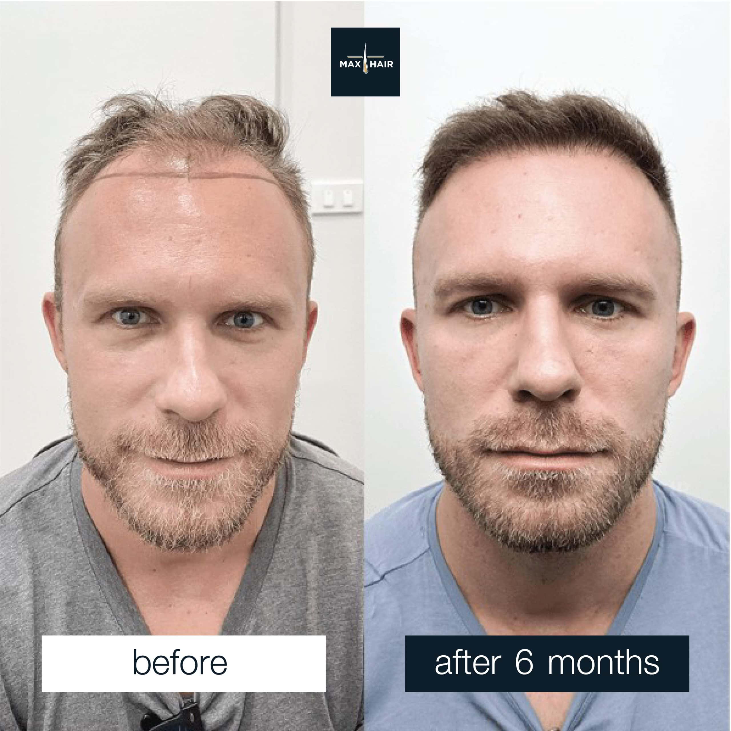 6-month hair transplant progress in man showing restored density and lowered hairline.