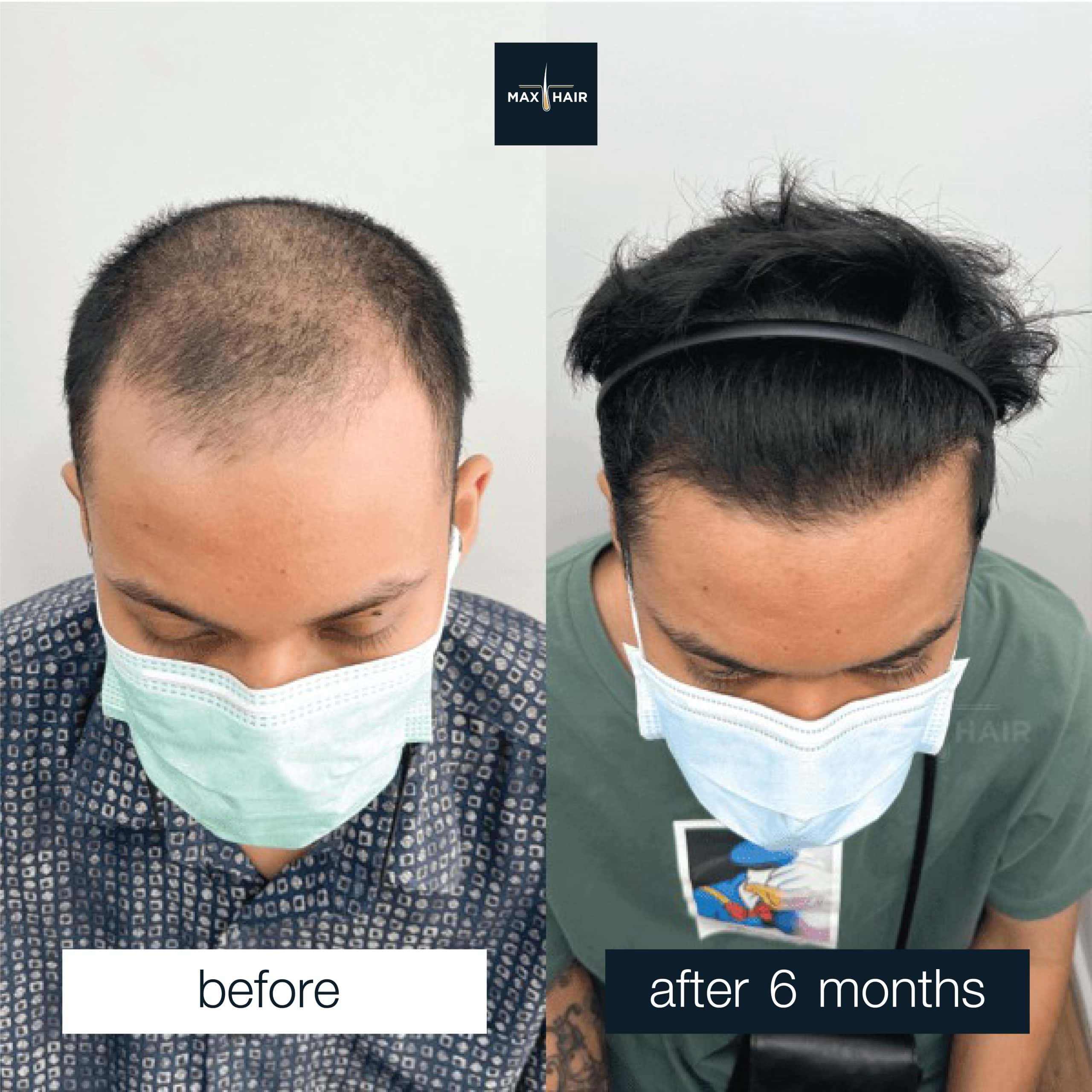 Before and after hair transplant results showing natural hair growth