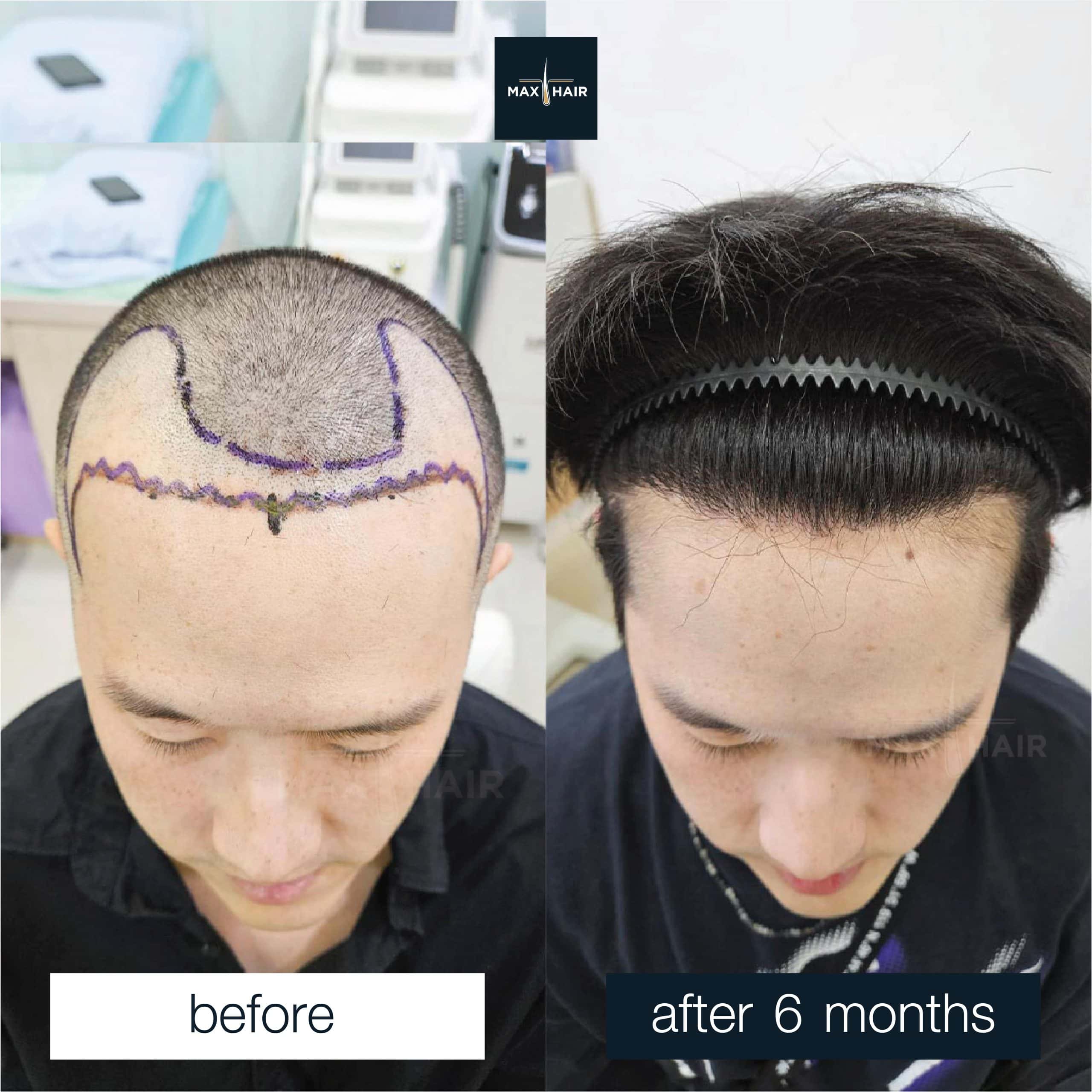 Marked hairline to full coverage after 6 months of hair transplant in man with frontal hair loss.