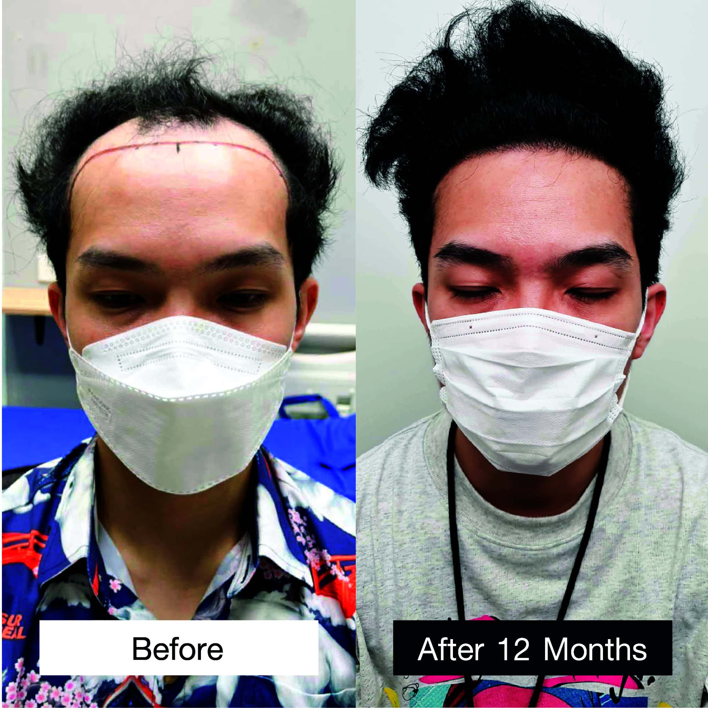 View all male hair transplant case reviews and results at Max Hair Clinic