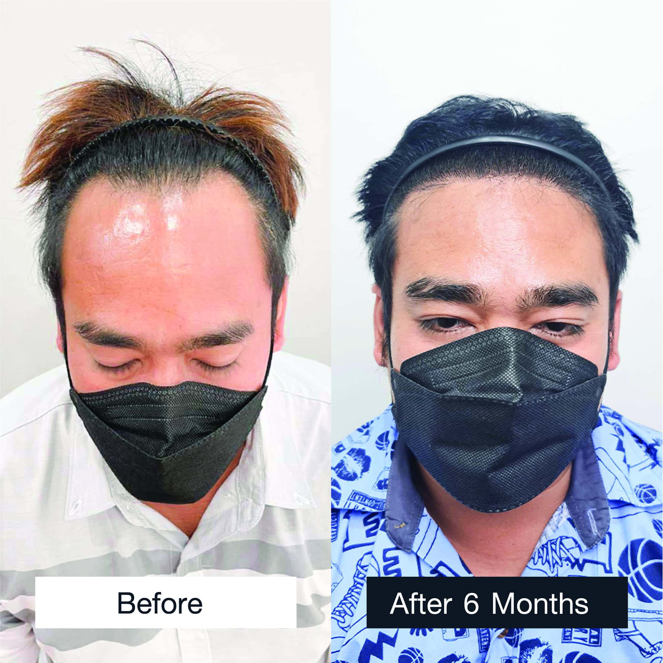 Close-up of hairline improvement after hair restoration treatment