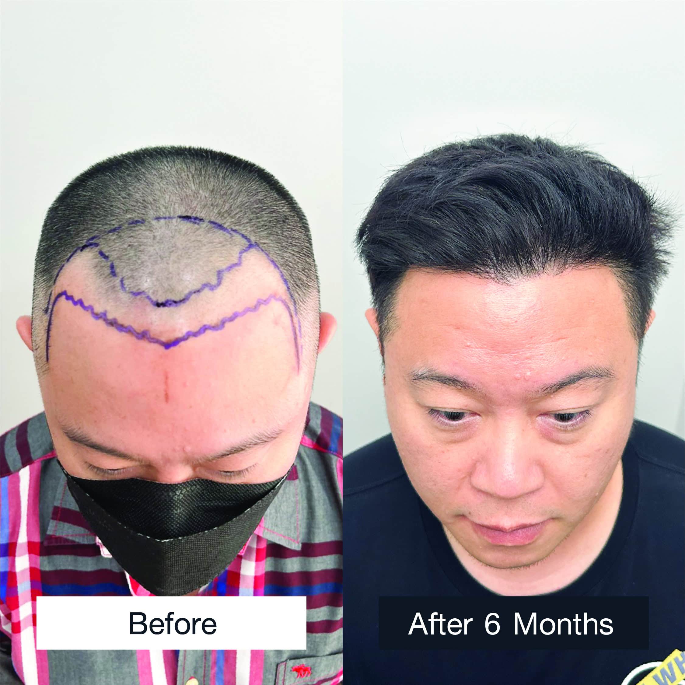 Hair transplant result in man with M-shaped hairline after 6 months, showing natural regrowth.