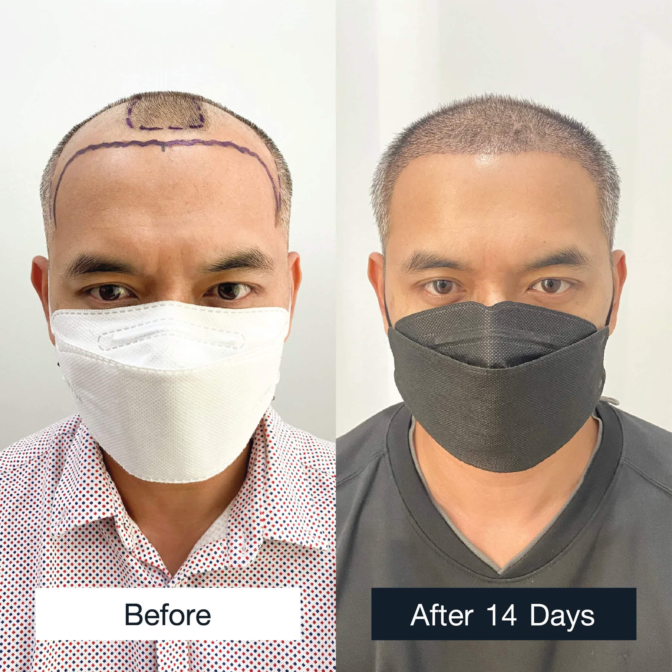 View all male hair transplant case reviews and results at Max Hair Clinic