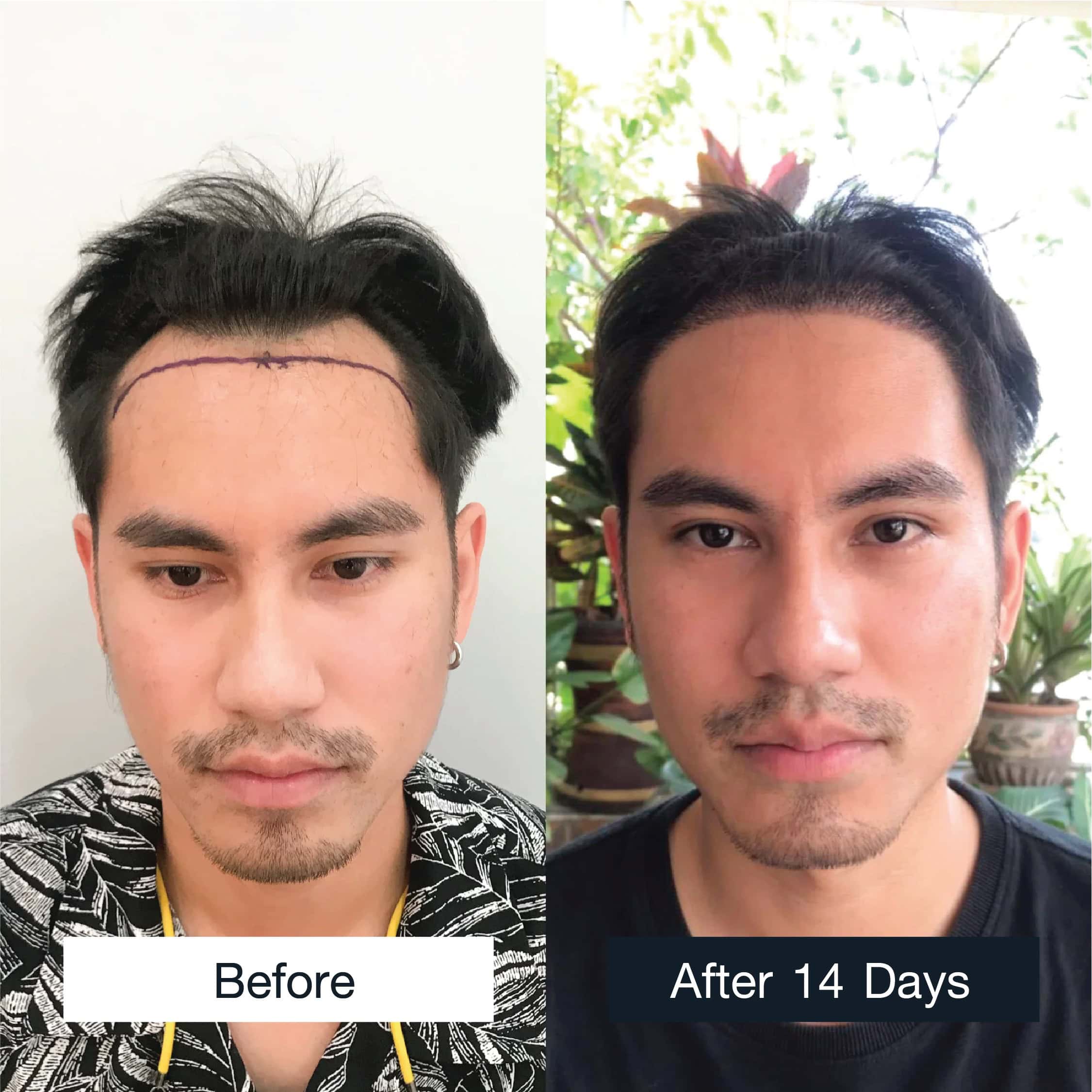 Male FUE hair transplant results 2,000 grafts after 14 days