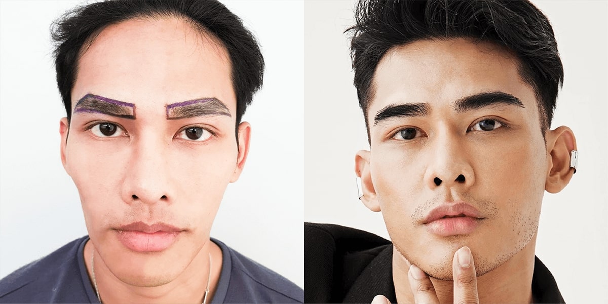 ภาพก่อน-หลังปลูกคิ้วที่ Max Hair Clinic