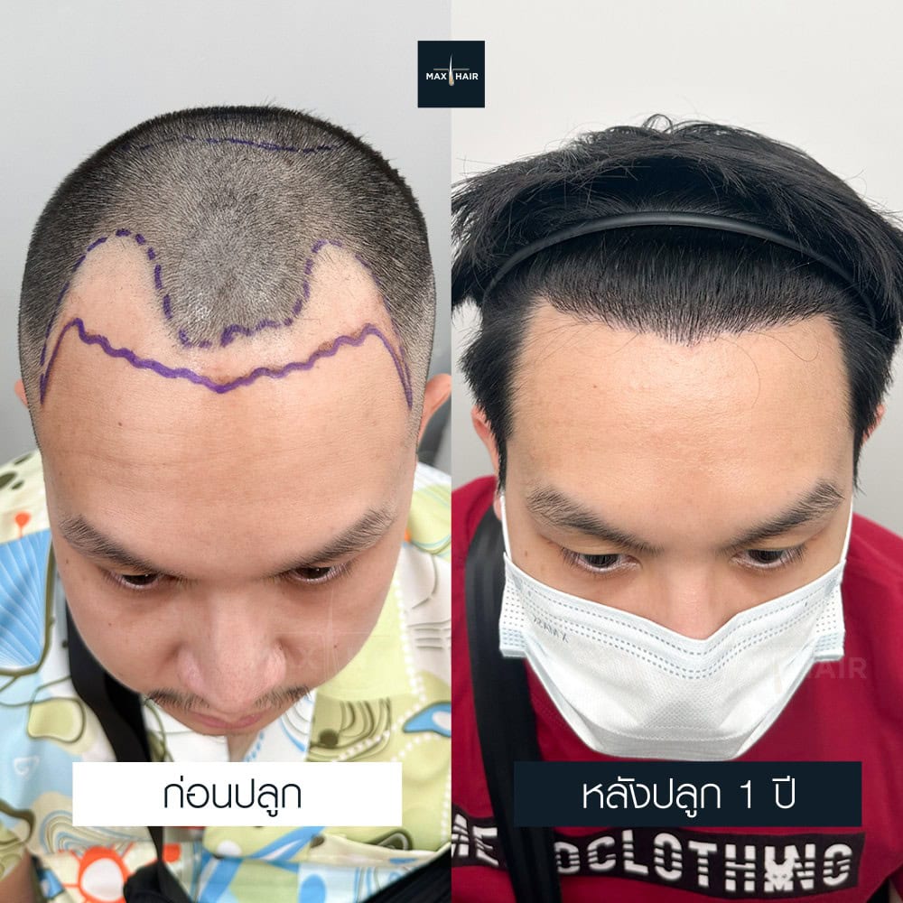 ปลูกผม FUE 2400 กราฟ คุณธนภัทร ตันซื่อ - Max Hair (2)