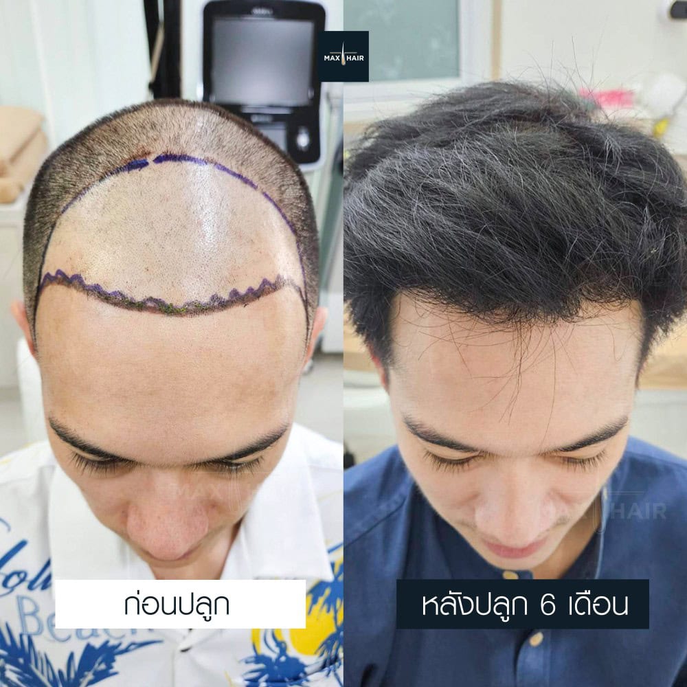 ปลูกผม MCG 3500 กราฟ คุณวิทวัส คงธะรังษี - Max Hair (1)