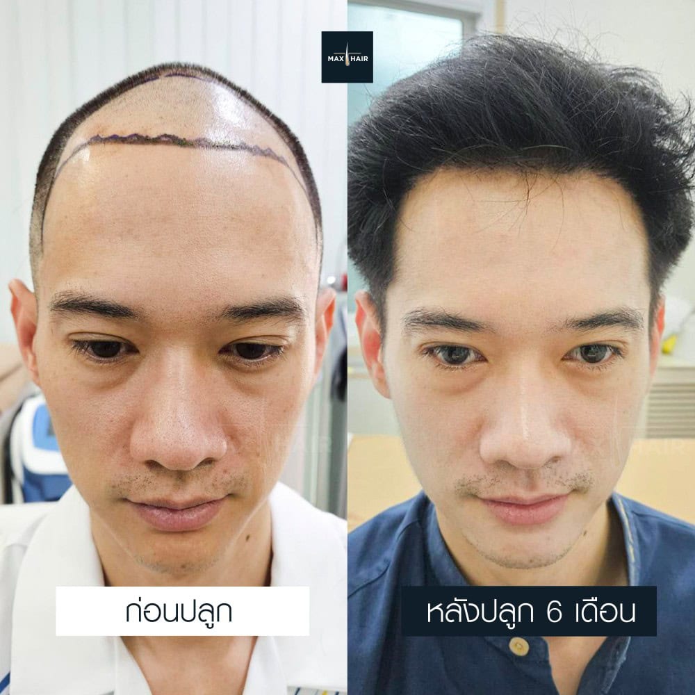 ปลูกผม MCG 3500 กราฟ คุณวิทวัส คงธะรังษี - Max Hair (2)