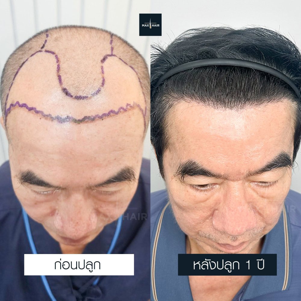 ปลูกผม MCG 3500 กราฟ คุณสมเกียรติ ดำริการเลิศ - Max Hair (2)