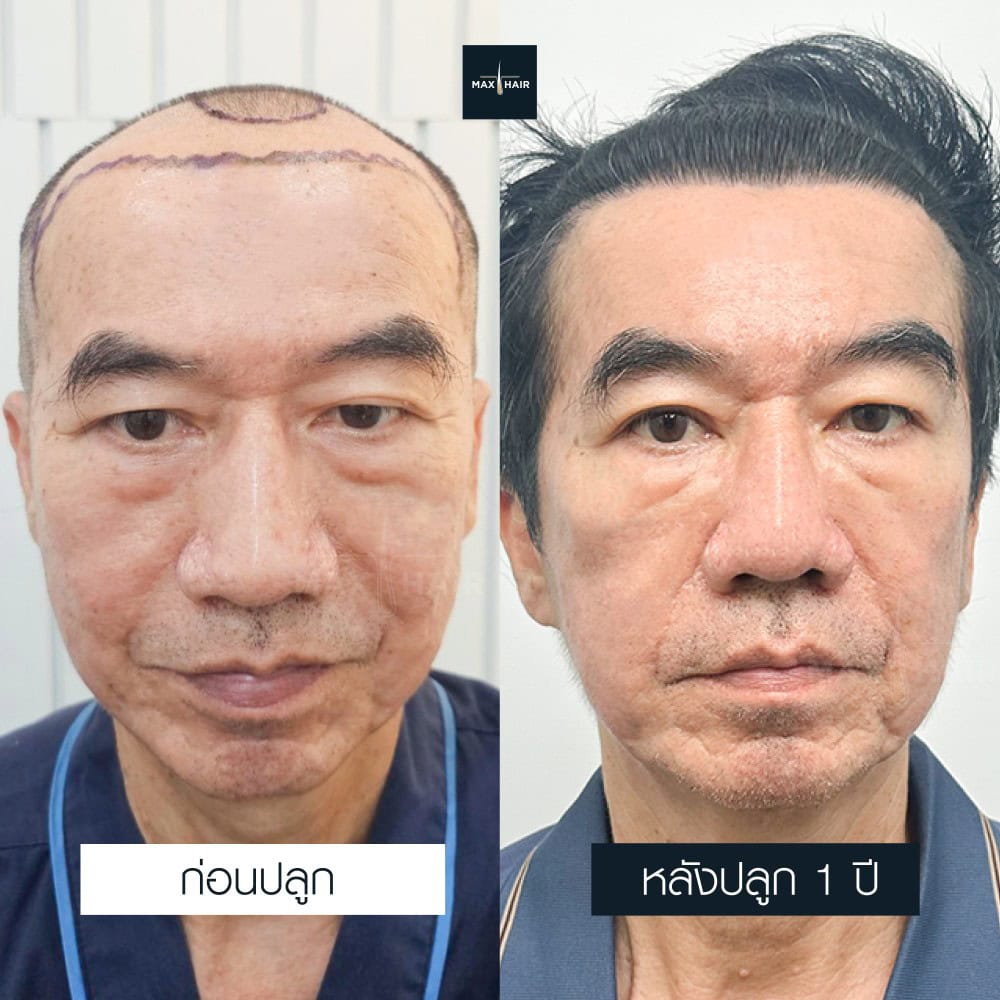 ปลูกผม MCG 3500 กราฟ คุณสมเกียรติ ดำริการเลิศ - Max Hair (1)