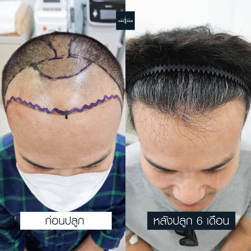 ปลูกผม MCG 3250 กราฟ คุณสุคิด ประดับภูทอง - Max Hair (1)