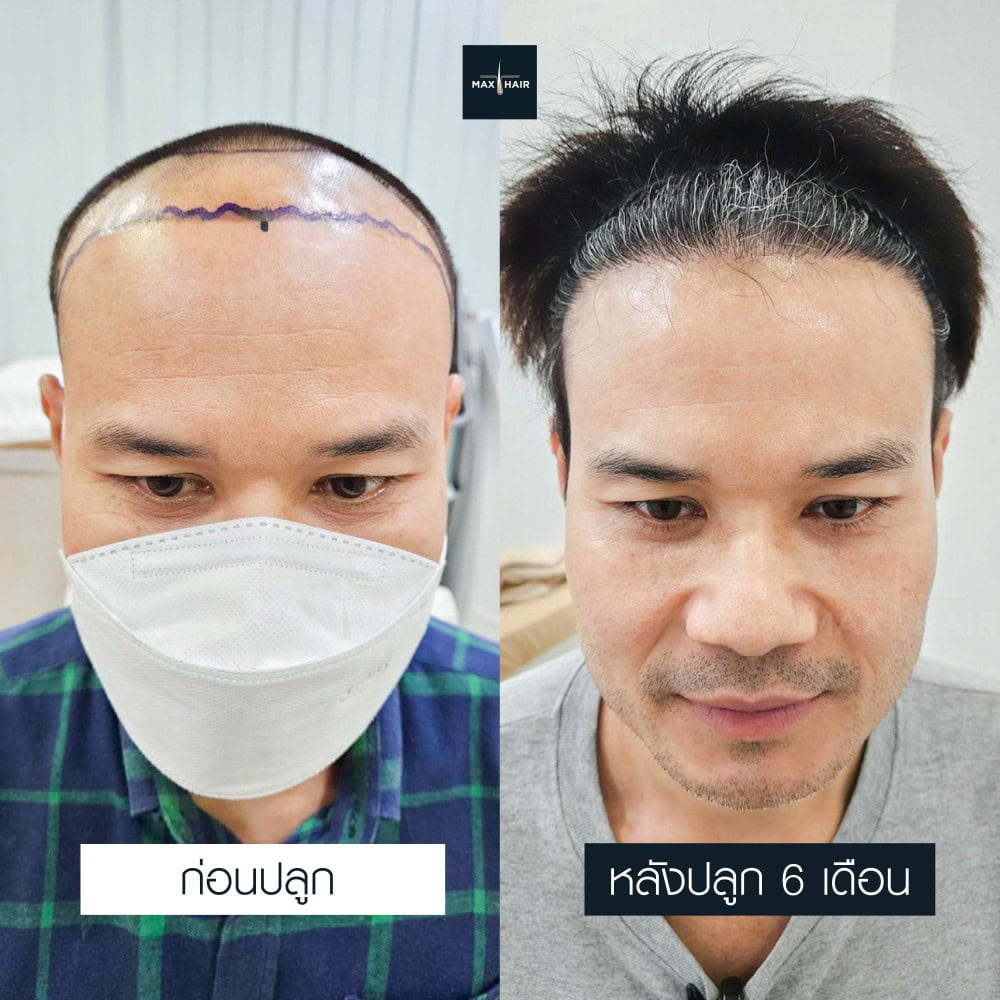 ปลูกผม MCG 3250 กราฟ คุณสุคิด ประดับภูทอง - Max Hair (2)