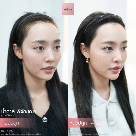 ปลูกผม Long Hair 1500กราฟ - รีวิวปลูกผมดารา (3)