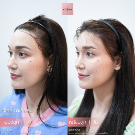 ปลูกผม Long Hair - รีวิวปลูกผมดารา (2)