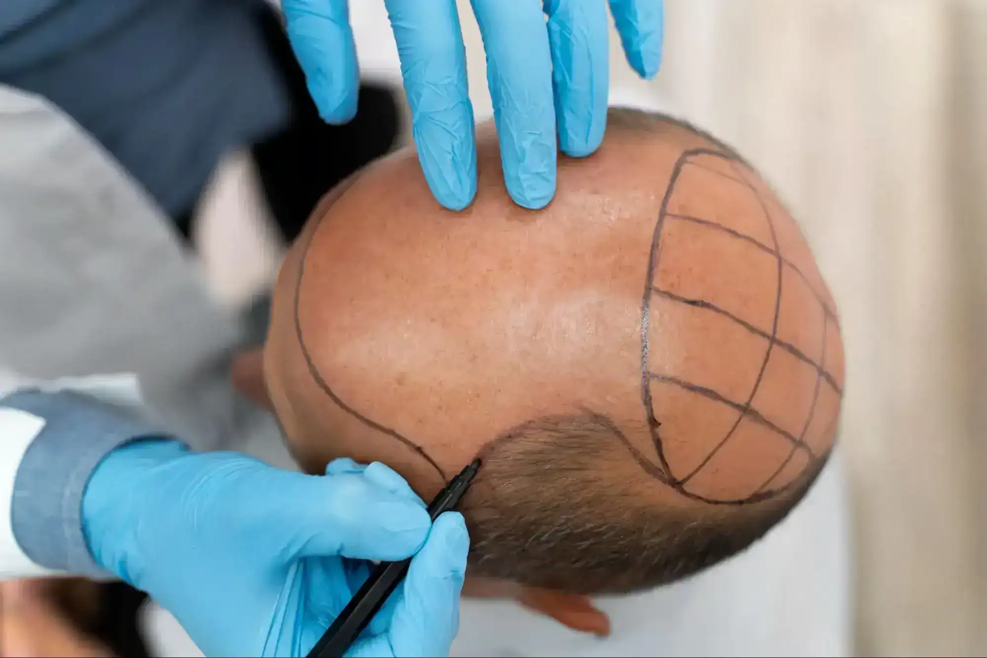 ขั้นตอนปลูกผม Max Hair Clinic