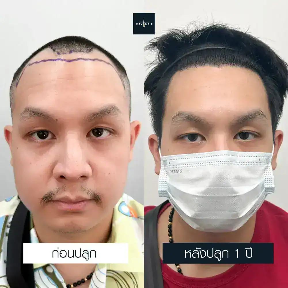 รีวิวปลูกผม Max Hair Clinic ก่อนและหลังทำ