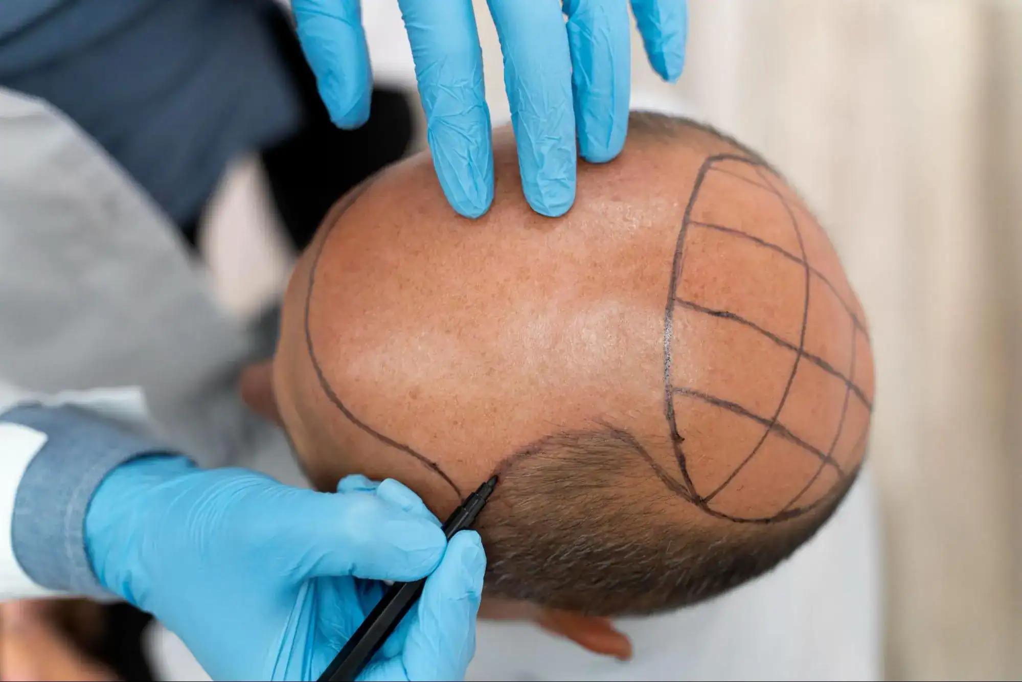 What is Hair Transplant