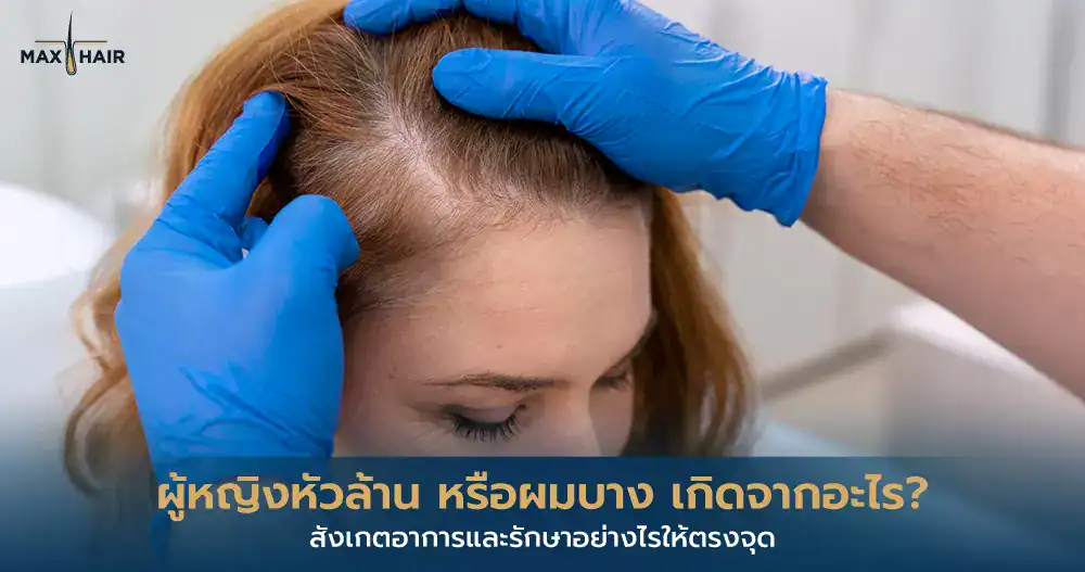 ผู้หญิงหัวล้าน