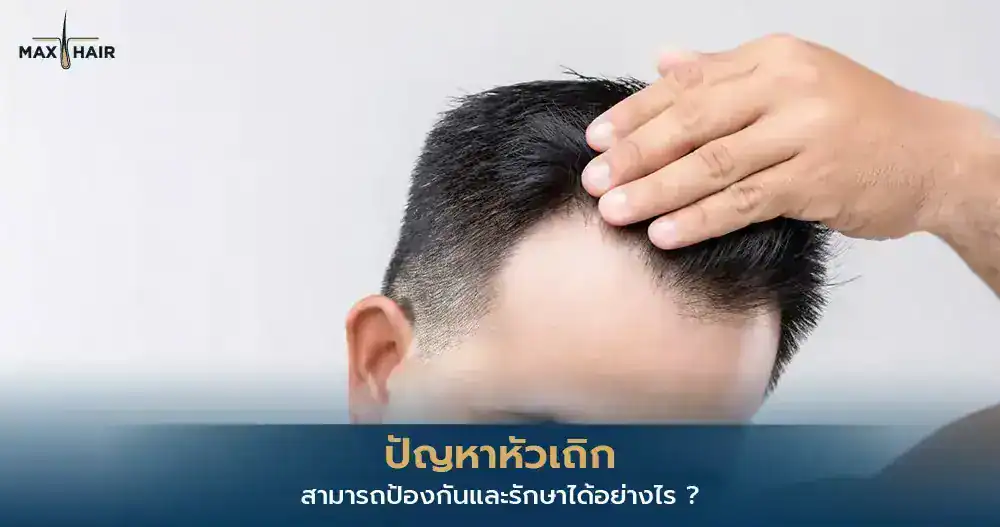 หัวเถิก แนวผมร่นบริเวณหน้าผาก